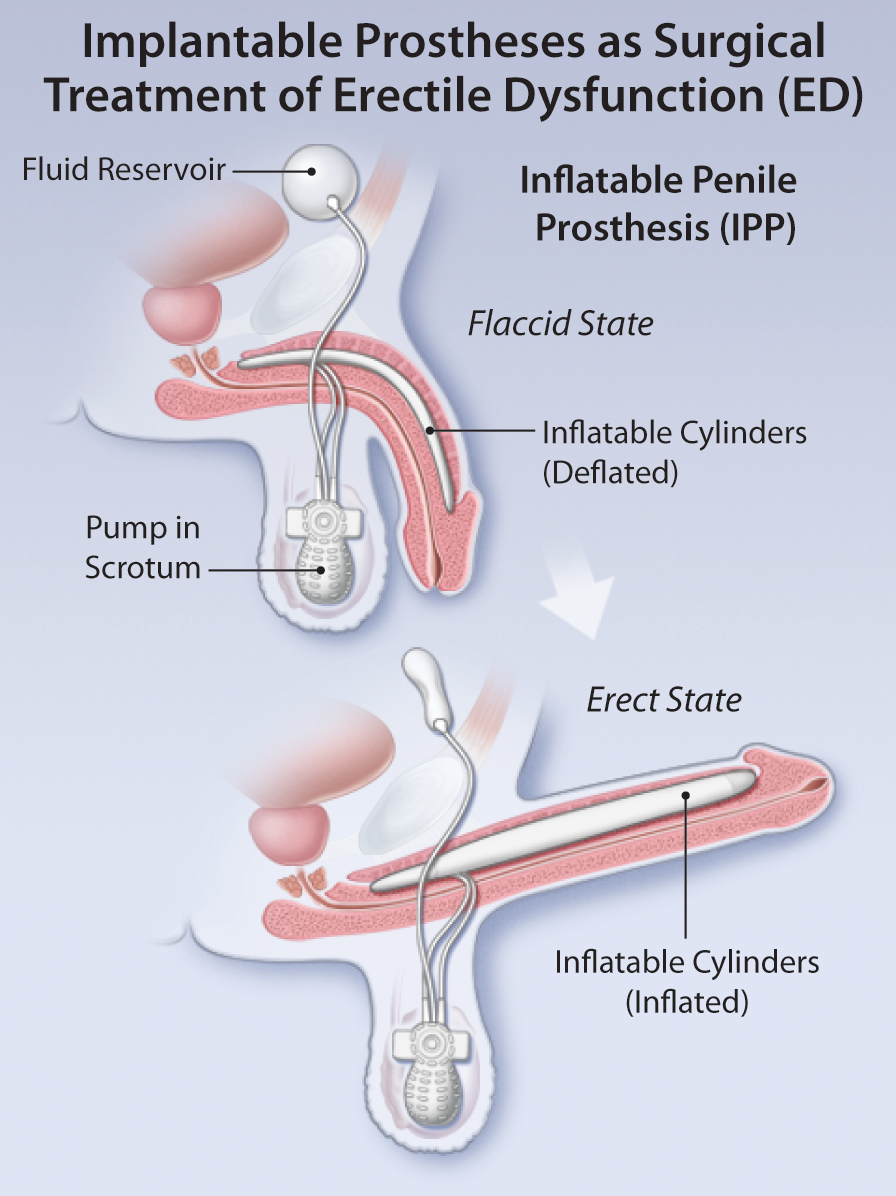 Invasive Treatments of Erectile Dysfunction (ED) - - Australian Pharmacy